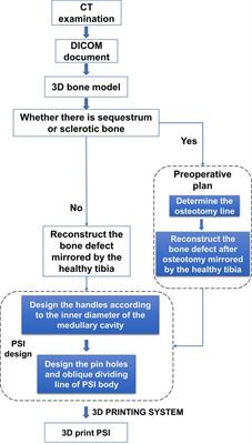 Application of 3D printed patient-specific instruments in the treatment of large tibial bone defects by the Ilizarov technique of distraction osteogenesis